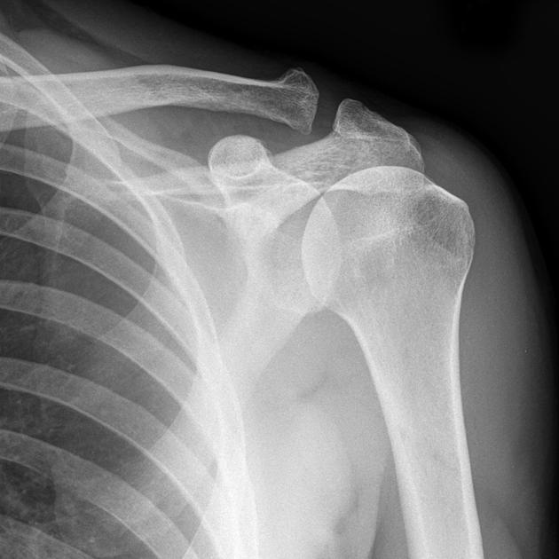 Shoulder Implant